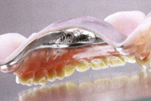 歯茎の健康と噛み心地を考えた入れ歯の新技術「コンフォート」